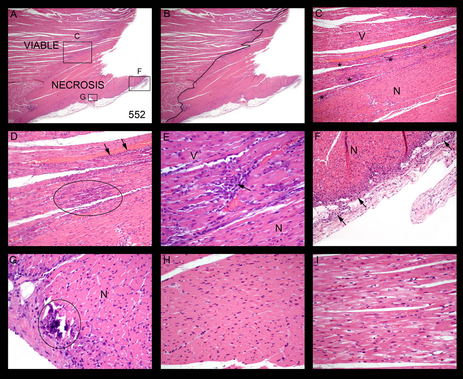 552 infarct LR