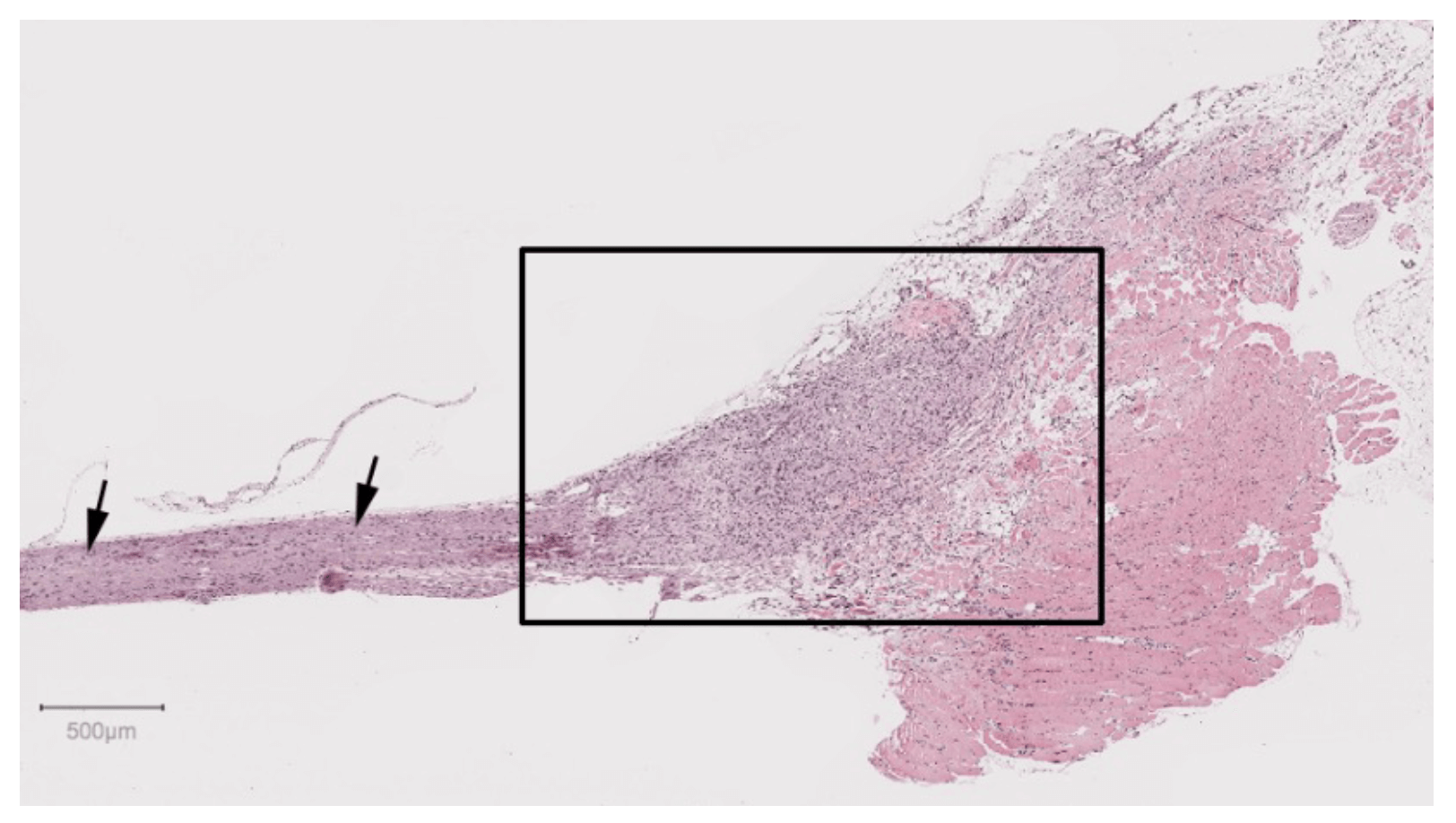 Neuroma 3