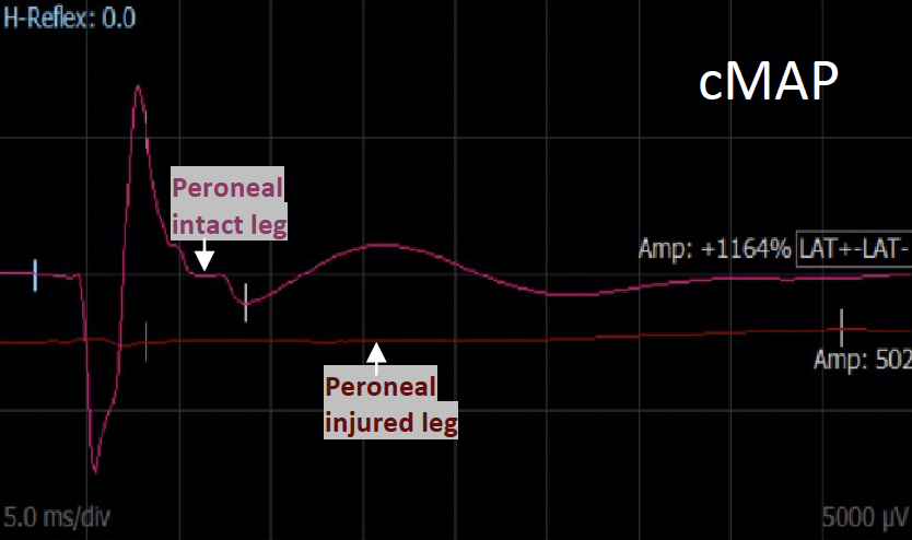 cMAP in peripheral nerve repair